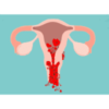 Menorrhagia